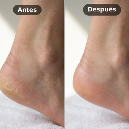 Removedor Exfoliador de Callos Eléctrico LuvePro