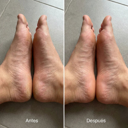 Removedor Exfoliador de Callos Eléctrico LuvePro